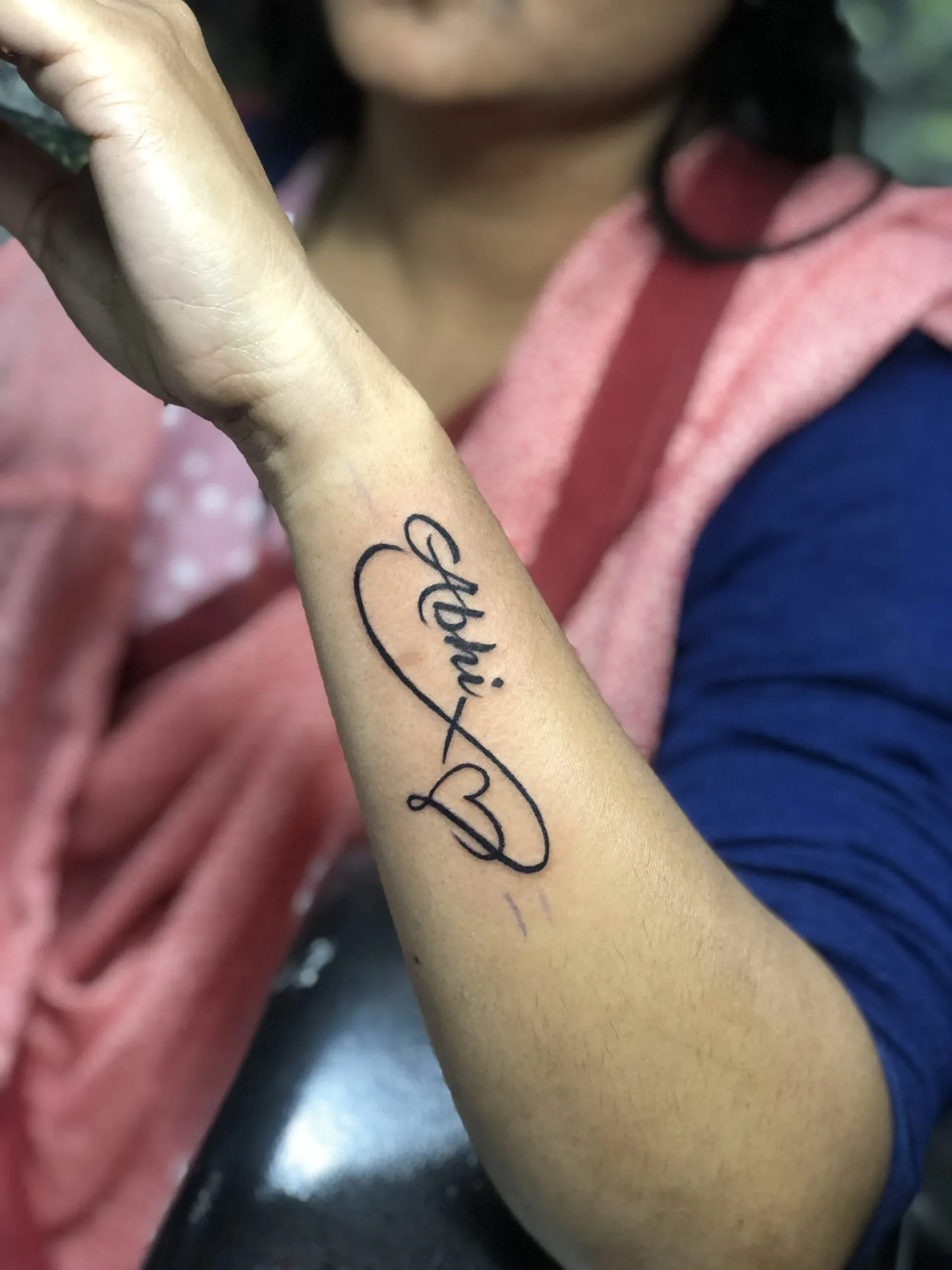 Tattoo Removal - Case Study - Ananya Chaudhry | Dr. Sumit Gupta